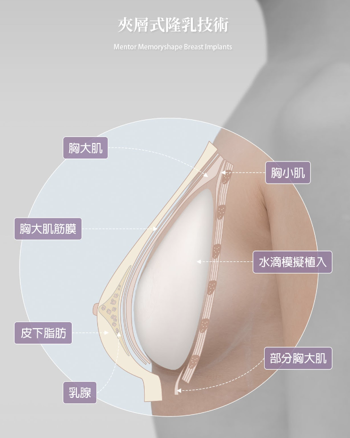 夾層式隆乳技術介紹