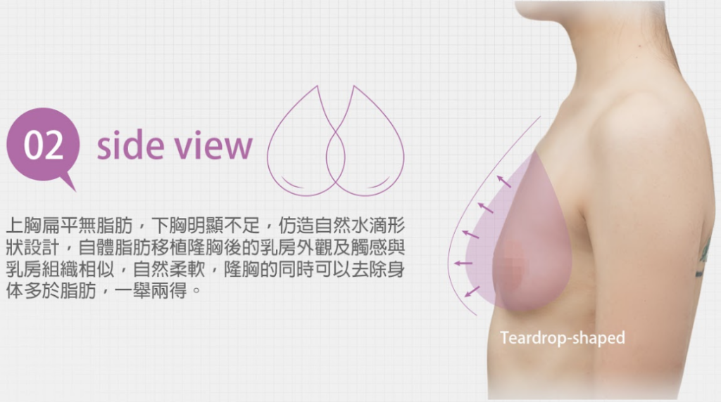 自體脂肪豐胸說明側面